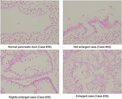 Negative correlation between the nuclear size and nuclear Lamina component Lamin A in intraductal papillary mucinous neoplasms of the pancreas